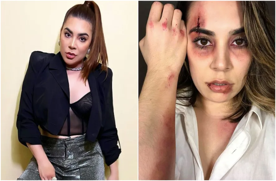 Cantora Naiara Azevedo revela hematomas após acusação de violência contra ex marido